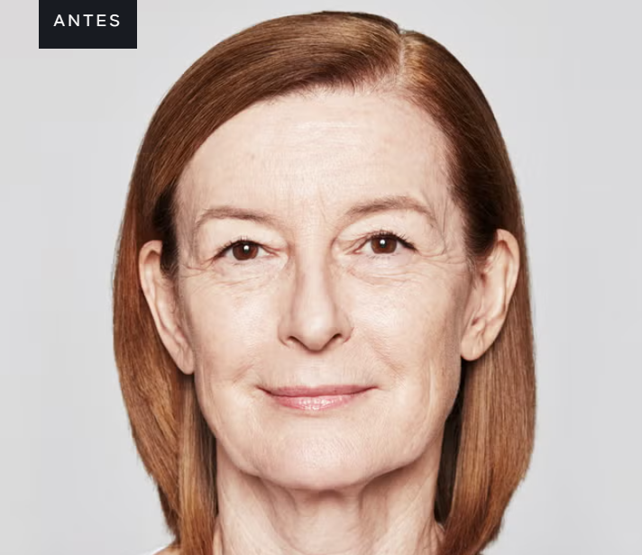 Paciente antes do tratamento com Sculptra — perda de volume facial