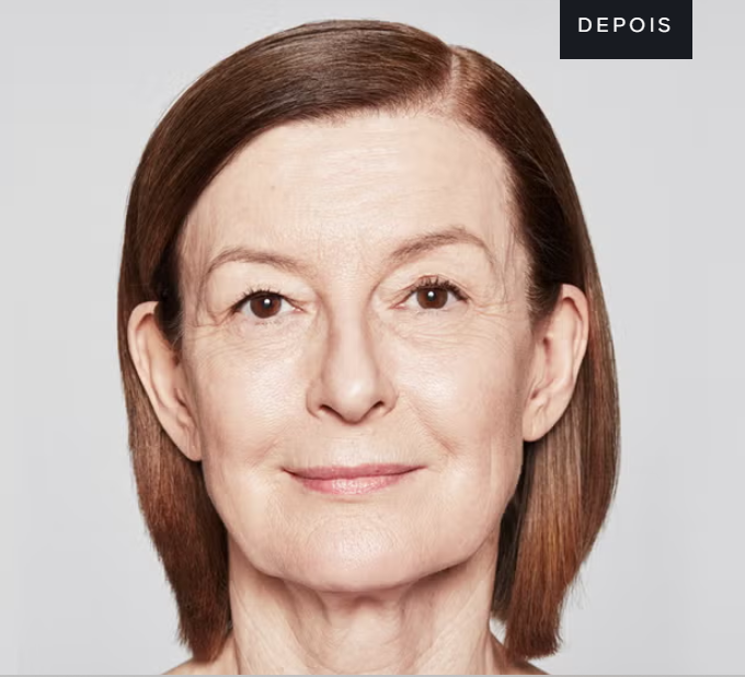 Paciente depois do tratamento com Sculptra — restauracao de volume e firmeza facial